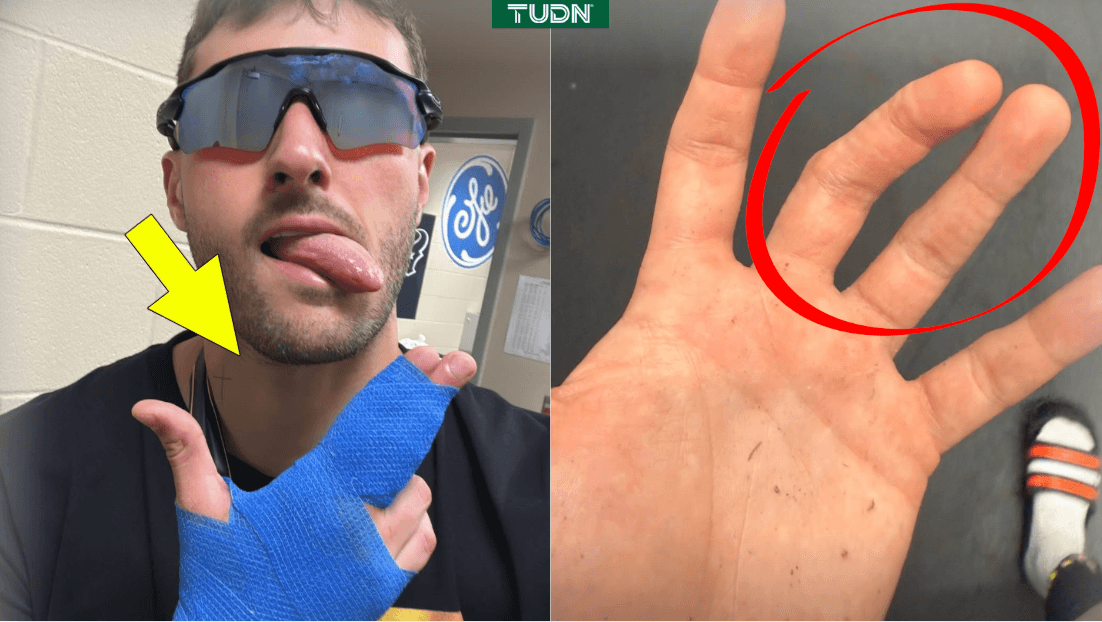 ¡De impacto! Así le quedó la mano a Santi tras pisotón en la Final